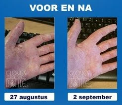 Groothandel π Gloves In A Bottle (GIAB) | Beschermende, Hydraterende En Herstellende Lotion | Eczeem, Droge Huid, Psoriasis |2 X 240 Ml Voordeelverpakking π€© 10 Groothandel π Gloves In A Bottle (GIAB) | Beschermende, Hydraterende En Herstellende Lotion | Eczeem, Droge Huid, Psoriasis |2 X 240 Ml Voordeelverpakking π€© -La Roche Shop 550x213