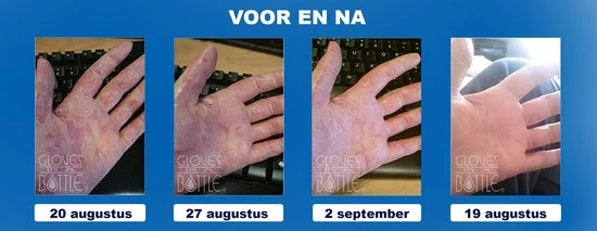 Groothandel π Gloves In A Bottle (GIAB) | Beschermende, Hydraterende En Herstellende Lotion | Eczeem, Droge Huid, Psoriasis |2 X 240 Ml Voordeelverpakking π€© 6 Groothandel π Gloves In A Bottle (GIAB) | Beschermende, Hydraterende En Herstellende Lotion | Eczeem, Droge Huid, Psoriasis |2 X 240 Ml Voordeelverpakking π€© - Afbeelding 4