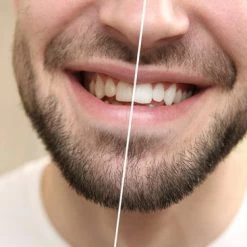 Korting π Moist-R Teeth Whitening Stick (2X) En 5 Refills - Thuis Tanden Bleken - Witte Tanden π₯ 13 Korting π Moist-R Teeth Whitening Stick (2X) En 5 Refills - Thuis Tanden Bleken - Witte Tanden π₯ -La Roche Shop 550x366 29