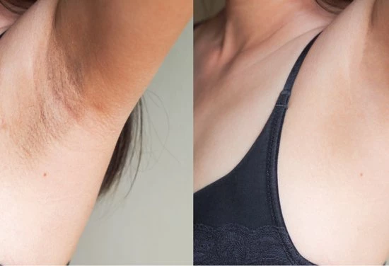 Nieuw π YlONN Róa Behandellotion - 90ml - Voorkomt Hyperpigmentatie - Huidirritatie Door Ontharen - Tegen Ingegroeide Haartjes π 5 Nieuw π YlONN Róa Behandellotion - 90ml - Voorkomt Hyperpigmentatie - Huidirritatie Door Ontharen - Tegen Ingegroeide Haartjes π - Afbeelding 3