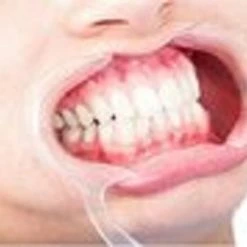 Korting 🎁 Merkloos 10 Stuks Mondspreiders Maat M- Voor Tandenbleken - Tandheelkundig Werk - Mondspreider - Wang Opener 💯 -La Roche Shop 550x394 2