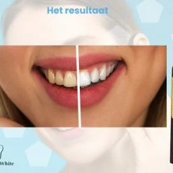 Gloednieuw ⭐ Glory Of White Professionele Tandsteen Verwijderaar - Elektrisch Tandplak Verwijderen - Tanden Polijsten 🥰 -La Roche Shop 550x412 20