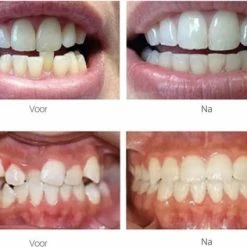 Goedkoopste π Gratyfied Rechte Tanden Zonder Beugel - Nachtbeugel Rechte Tanden - Rechte Tanden Bitje π 10 Goedkoopste π Gratyfied Rechte Tanden Zonder Beugel - Nachtbeugel Rechte Tanden - Rechte Tanden Bitje π -La Roche Shop 550x425 1