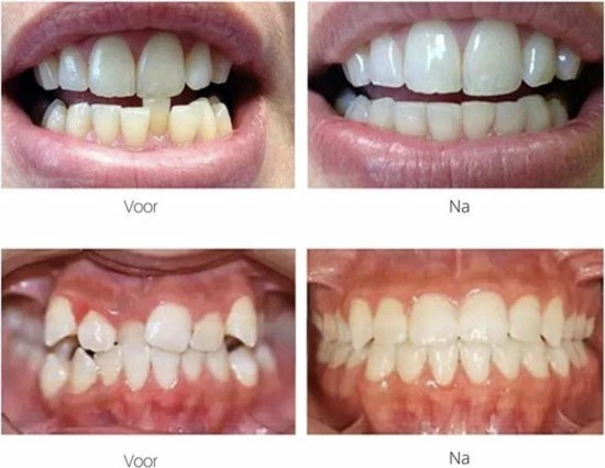 Goedkoopste π Gratyfied Rechte Tanden Zonder Beugel - Nachtbeugel Rechte Tanden - Rechte Tanden Bitje π 5 Goedkoopste π Gratyfied Rechte Tanden Zonder Beugel - Nachtbeugel Rechte Tanden - Rechte Tanden Bitje π - Afbeelding 3