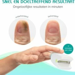 Gloednieuw 👍 Sellexy Anti Schimmelnagel Zelf-laserapparaat Incl. Pedicure Set 🧨 -La Roche Shop 550x513 2