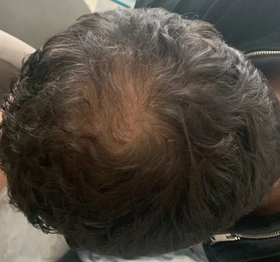 Beste deal π₯ Ouini's Olie Ouini's Knoflookolie- Haar Uitval - Haargroei Olie - Knoflook Olie - Eczeem- Acne - Psoriasis - Rosacea - Alopecia - Baardgroei π 9 Beste deal π₯ Ouini's Olie Ouini's Knoflookolie- Haar Uitval - Haargroei Olie - Knoflook Olie - Eczeem- Acne - Psoriasis - Rosacea - Alopecia - Baardgroei π - Afbeelding 7