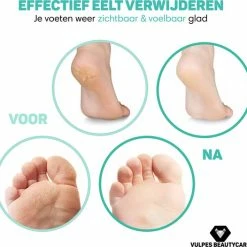 Kopen 🎁 Vulpes Goods Vulpes BeautyCare® Elektrische Eelt Verwijderaar Pro – Stofzuigfunctie – 3 Snelheden – Inclusief 3 Vijlschijven & Borstel - USB-Oplaadbaar 😀 -La Roche Shop 550x526 2