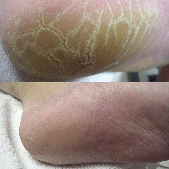 Groothandel 🔔 Footlogix Cracked Heel Formula 👏 4 Groothandel 🔔 Footlogix Cracked Heel Formula 👏 - Afbeelding 2