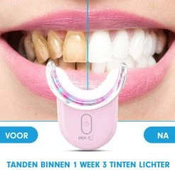 Uitgang ๐ DEN-T® U-shape PRO - Tandenbleekset - 32 LED - Zonder Peroxide - Tandenbleken - Teeth Whitening - Roze - ๐ฅ 18 Uitgang ๐ DEN-T® U-shape PRO - Tandenbleekset - 32 LED - Zonder Peroxide - Tandenbleken - Teeth Whitening - Roze - ๐ฅ -La Roche Shop 550x550 354