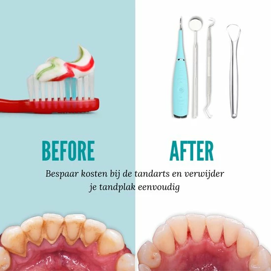 Beste Pirce β Shiney Tandsteen Verwijderaar - Tandplak Verwijderaar - Tanden Polijsten - Inclusief Tandarts Set - Tongschraper - Tandartshaakje - Elektrisch - 4 Delig - 5 Standen - Sonisch π 8 Beste Pirce β Shiney Tandsteen Verwijderaar - Tandplak Verwijderaar - Tanden Polijsten - Inclusief Tandarts Set - Tongschraper - Tandartshaakje - Elektrisch - 4 Delig - 5 Standen - Sonisch π - Afbeelding 6